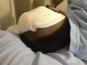 頭部解答血腫除去手術後の写真